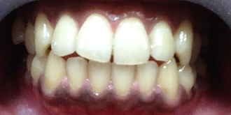 ホワイトニング効果例1 after