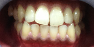 ホワイトニング効果例1 before