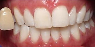 ホワイトニング効果例2 after