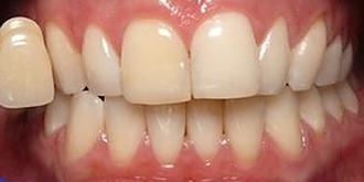 ホワイトニング効果例2 before